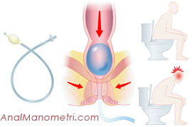 Anal Manometri, balon itme