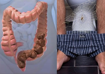 Anal Manometri, kabızlık