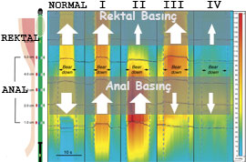Anal Manometri, dissinerji