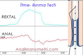 Anal Manometri, ıkınma itme grafik