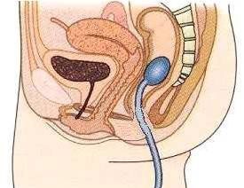 Kateterin makat içine yerleştirilmesi Kateterin makat içine yerleştirilmesi