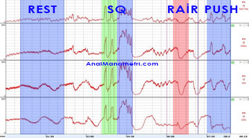 Sulu sistem 4 Kanallı Klasik Anal Manometri