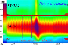 Anal Manometri, öksürük