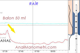 Anal Manometri,RAİR grafik