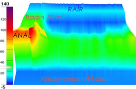 Anal Manometri, RAİR 3D