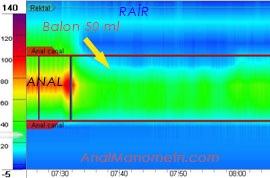 Anal Manometri, RAİR