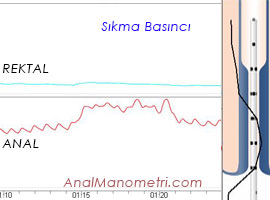Anal Manometri, sıkma grafik