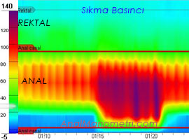 Anal Manometri, sıkma