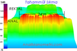 Anal Manometri, tahammül sıkma 3D